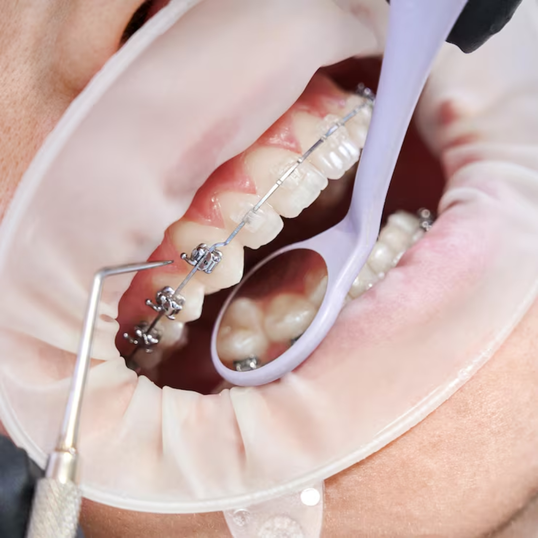 The Adult Braces Boom: Why It’s Never Too Late for a Perfect Smile